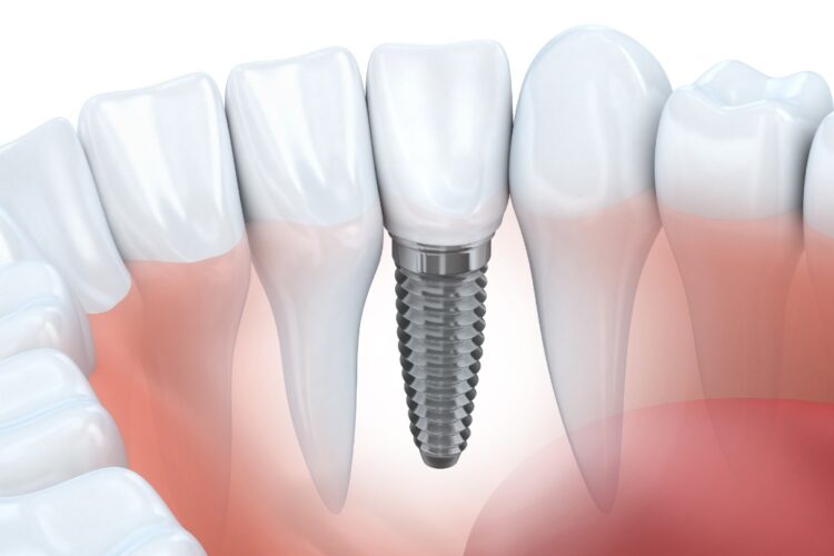 Dental Implants Seattle, WA